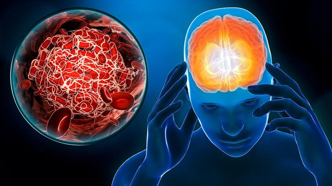 Prise en charge de l’AVC : « le Sénégal n’a que de 5 lits de réanimation neurologique »