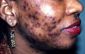 Dépigmentation (xéssal) : Dr Fatoumata Ly révèle un taux de mortalité alarmant