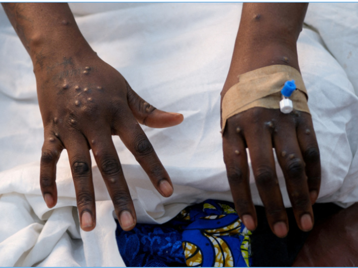 Mpox: l’OMS maintient son plus haut niveau d’alerte