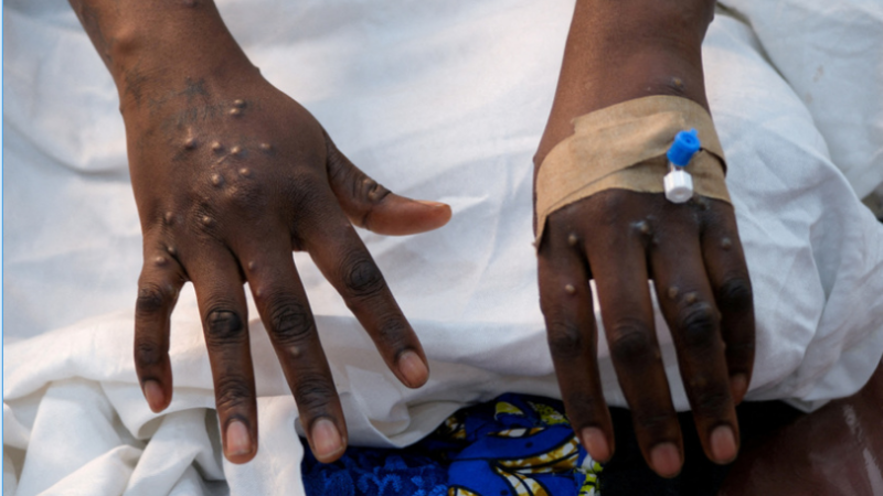 Mpox: l’OMS maintient son plus haut niveau d’alerte