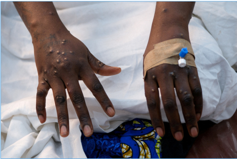 Mpox: l’OMS maintient son plus haut niveau d’alerte